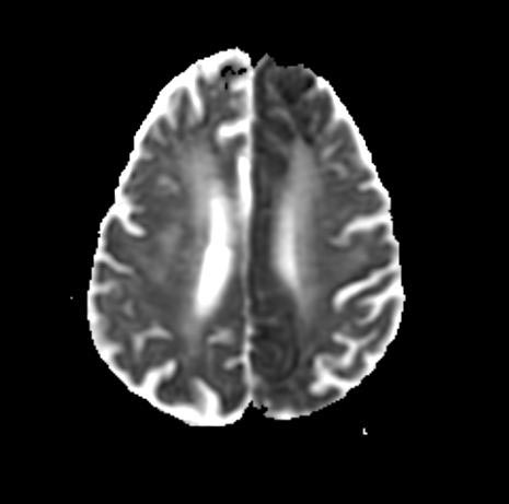File:Cerebrovascular accident (Radiopaedia 11291-11655 Axial ADC 1).jpg
