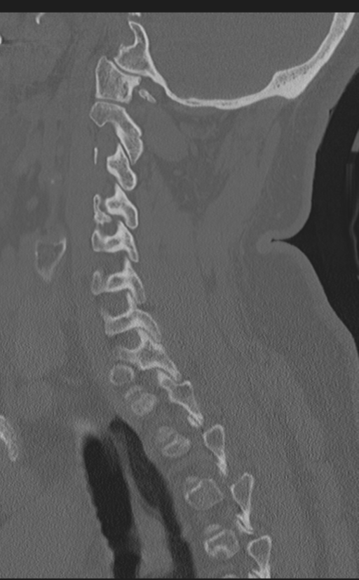 Cervical canal stenosis due to ossification of the posterior longitudinal ligament (Radiopaedia 47260-51823 Sagittal bone window 50).png