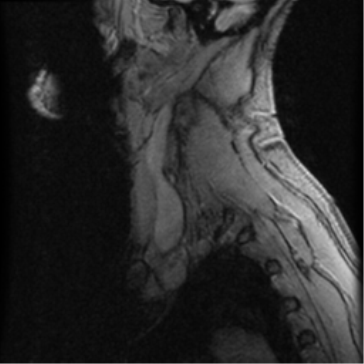 File:Cervical canal stenosis with cord compression (Radiopaedia 34114-35374 D 1).png