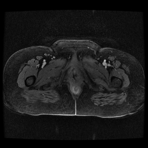 Cervical carcinoma (Radiopaedia 70924-81132 Axial T1 C+ fat sat 107).jpg