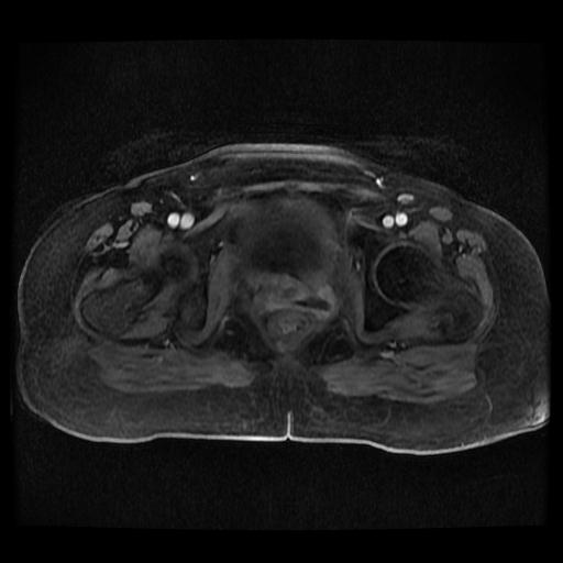 Cervical carcinoma (Radiopaedia 70924-81132 Axial T1 C+ fat sat 211).jpg