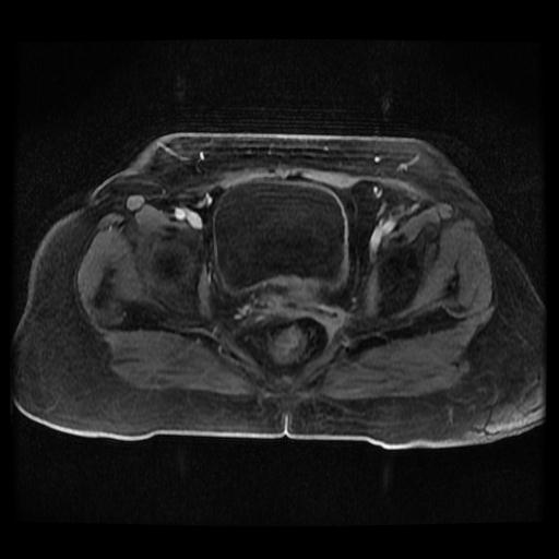 Cervical carcinoma (Radiopaedia 70924-81132 Axial T1 C+ fat sat 223).jpg