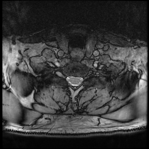 Cervical disc extrusion (Radiopaedia 59074-66364 G 82).jpg