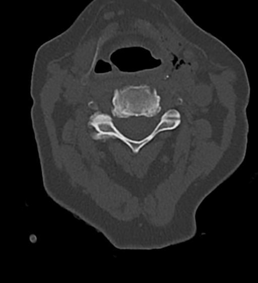 Cervical spine ACDF loosening (Radiopaedia 48998-54070 Axial bone window 26).png
