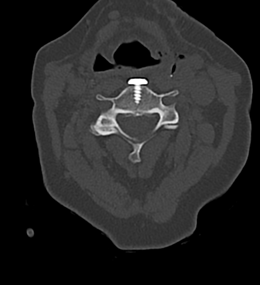 File:Cervical spine ACDF loosening (Radiopaedia 48998-54070 Axial bone window 28).png