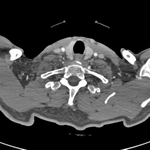 File:Cervical spine fractures with vertebral artery dissection (Radiopaedia 53296-59269 A 27).png