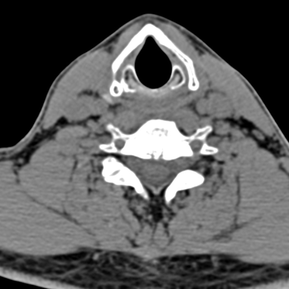 Cervical spondylodiscitis (Radiopaedia 28057-29489 Axial non-contrast 54).jpg