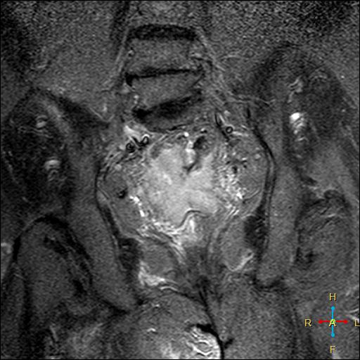 File:Cervical stump squamous cell carcinoma (Radiopaedia 48049-52858 G 8).jpg