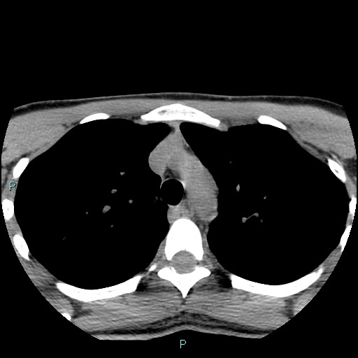 File:Cervical thymic cyst (Radiopaedia 88632-105335 Axial non-contrast 1).jpg