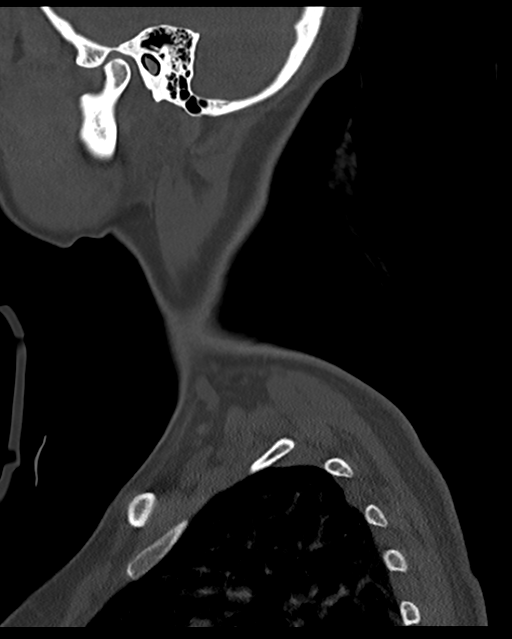 Cervical tuberculous spondylitis (Radiopaedia 39149-41365 Sagittal bone window 65).png