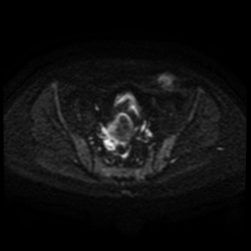 Cesarian section scar endometriosis (Radiopaedia 66520-75799 Axial DWI 83).jpg