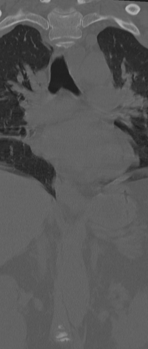 Chance fracture (Radiopaedia 33854-35020 Coronal bone window 22).png