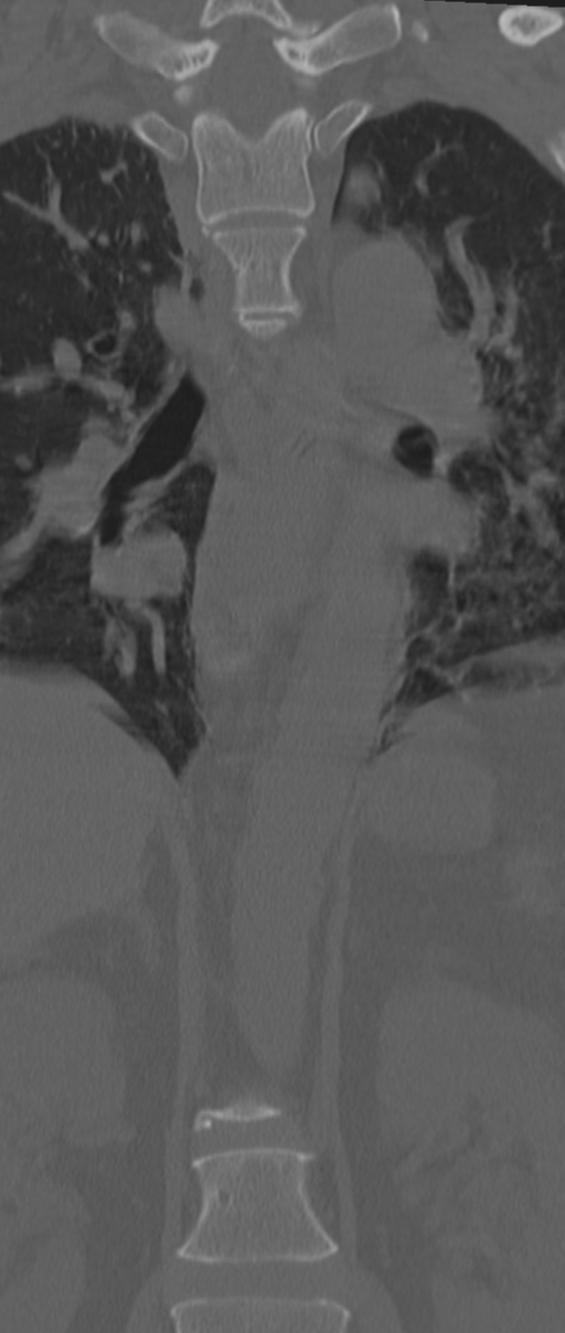 Chance fracture (Radiopaedia 33854-35020 Coronal bone window 32).png