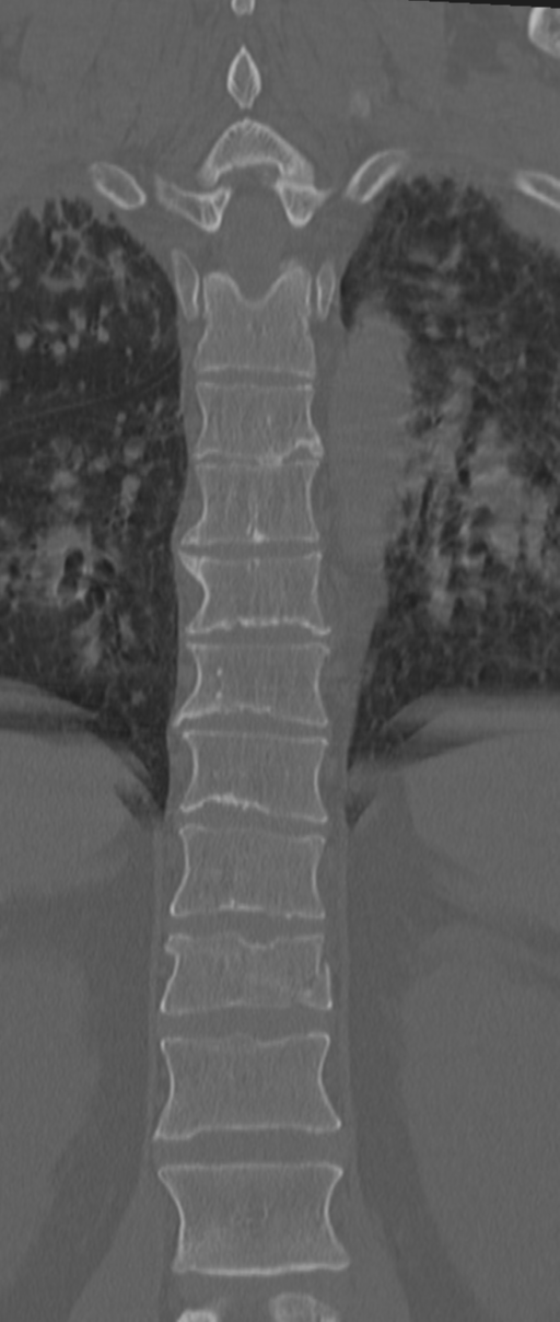 Chance fracture (Radiopaedia 33854-35020 Coronal bone window 47).png