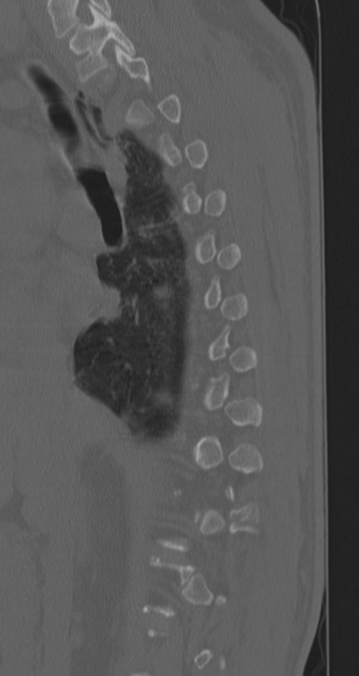 Chance fracture (Radiopaedia 33854-35020 Sagittal bone window 58).png