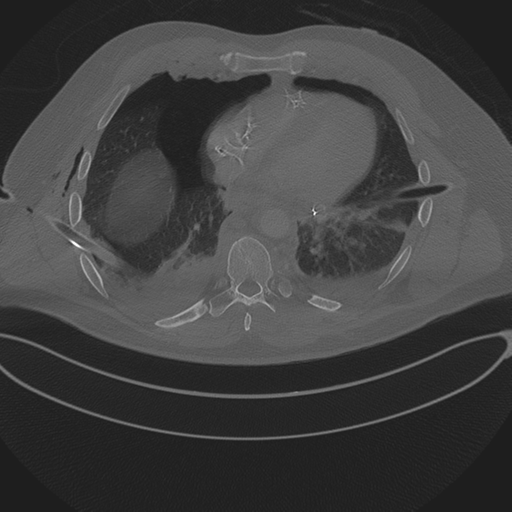 File:Chest multitrauma - aortic injury (Radiopaedia 34708-36147 Axial bone window 196).png