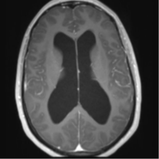 File:Chiari I malformation and obstructive hydrocephalus (Radiopaedia 41185-43978 Axial T1 C+ 19).png