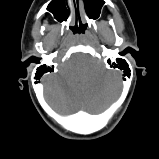 File:Chiari I malformation and obstructive hydrocephalus (Radiopaedia 41185-43981 D 27).png