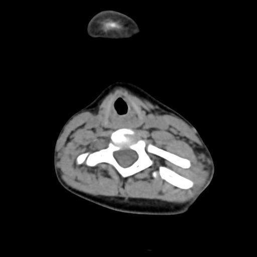 Chiari I with syrinx and skull base anomalies (Radiopaedia 89444-106412 Axial non-contrast 103).jpg