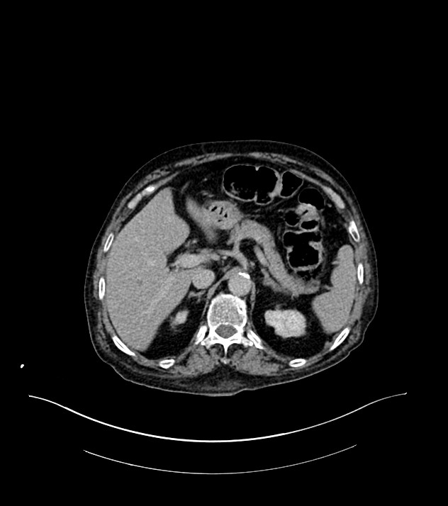 Cholangiocarcinoma with cerebral metastases (Radiopaedia 83519-98629 Axial C+ delayed 29).jpg