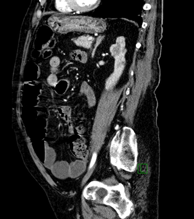 Cholangiocarcinoma with cerebral metastases (Radiopaedia 83519-98629 F 46).jpg