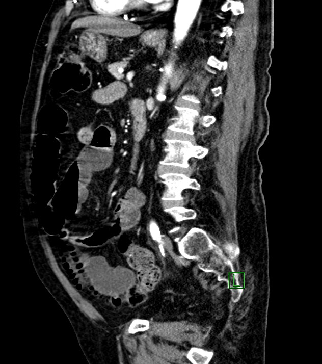Cholangiocarcinoma with cerebral metastases (Radiopaedia 83519-98629 F 53).jpg