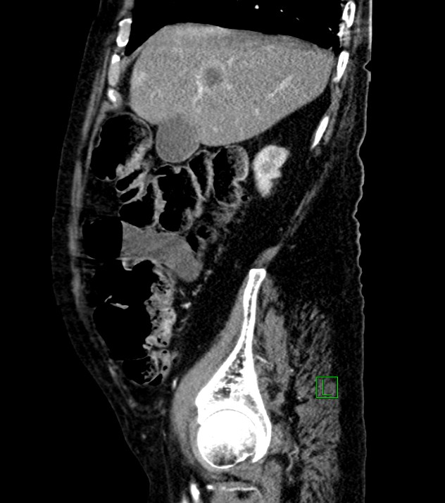 Cholangiocarcinoma with cerebral metastases (Radiopaedia 83519-98629 F 91).jpg