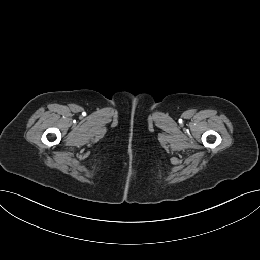 Cholecystoduodenal fistula due to calculous cholecystitis with gallstone migration (Radiopaedia 86875-103077 A 86).jpg