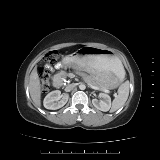 File:Choledochal cyst with chronic calcific pancreatitis (Radiopaedia 18245-18061 A 13).png