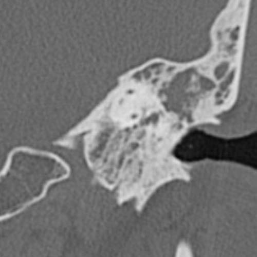 File:Cholesteatoma (Radiopaedia 9408-10093 Coronal bone window 2).jpg