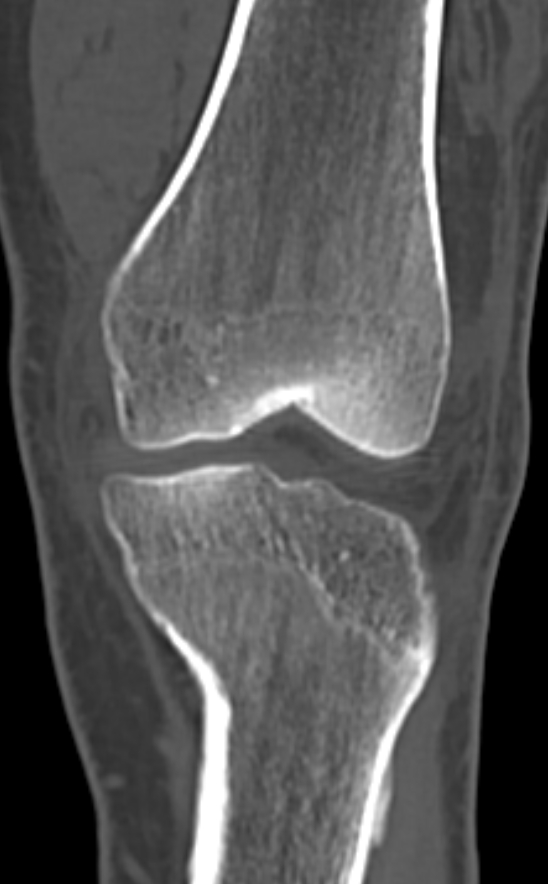 Chondrocalcinosis (Radiopaedia 82862-97173 Coronal bone window 30).jpg