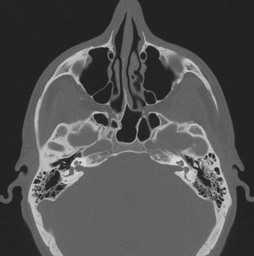 Chondrosarcoma (clivus) (Radiopaedia 46895-51425 Axial bone window 47).png