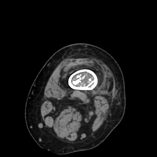 File:Chondrosarcoma - femur (Radiopaedia 64187-72954 Axial non-contrast 16).jpg