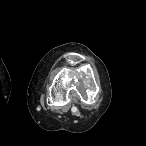Chondrosarcoma - femur (Radiopaedia 64187-72954 Axial with contrast 47).jpg