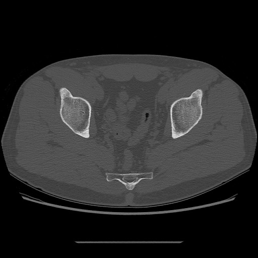 File:Chondrosarcoma of iliac wing (Radiopaedia 63861-72599 Axial bone window 88).jpg