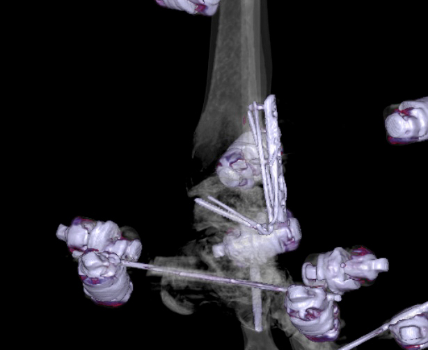 File:Chopart fracture (Radiopaedia 35347-36861 3D MPR bone window 35).jpg