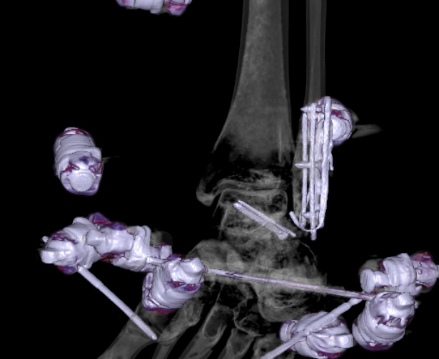 File:Chopart fracture (Radiopaedia 35347-36861 3D MPR bone window 4).jpg