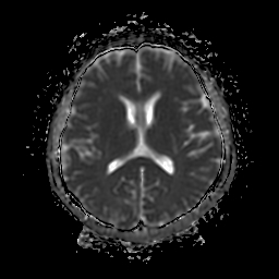 File:Chordoid glioma of third ventricle (Radiopaedia 91612-109340 Axial ADC 17).jpg