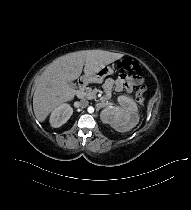 Chromophobe renal cell carcinoma (Radiopaedia 84239-99519 B 45).jpg