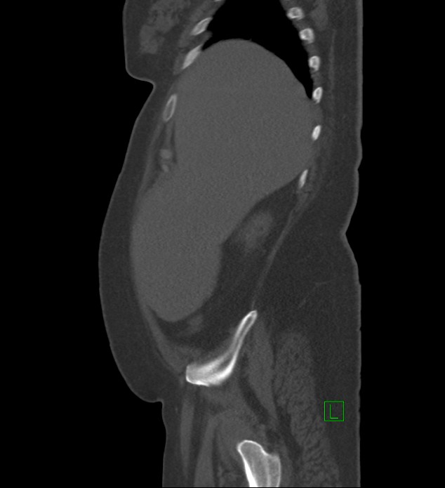 Chromophobe renal cell carcinoma (Radiopaedia 84239-99519 Sagittal bone window 90).jpg
