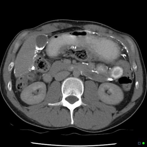 File:Chronic barium peritonitis and small bowel obstruction (Radiopaedia 29151-29548 D 5).jpg