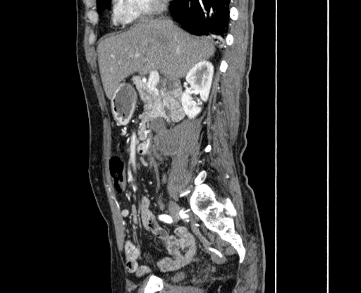 File:Chronic contained rupture of abdominal aortic aneurysm with extensive erosion of the vertebral bodies (Radiopaedia 55450-61901 B 10).jpg