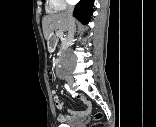 File:Chronic contained rupture of abdominal aortic aneurysm with extensive erosion of the vertebral bodies (Radiopaedia 55450-61901 B 19).jpg