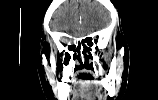 Chronic invasive fungal sinusitis (Radiopaedia 91563-109286 D 59).jpg