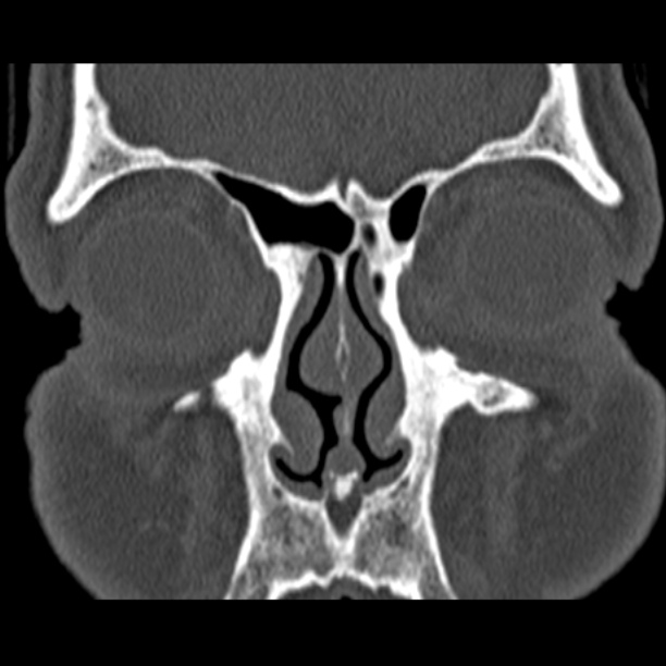 Chronic maxillary sinusitis (Radiopaedia 27879-28116 Coronal bone window 13).jpg