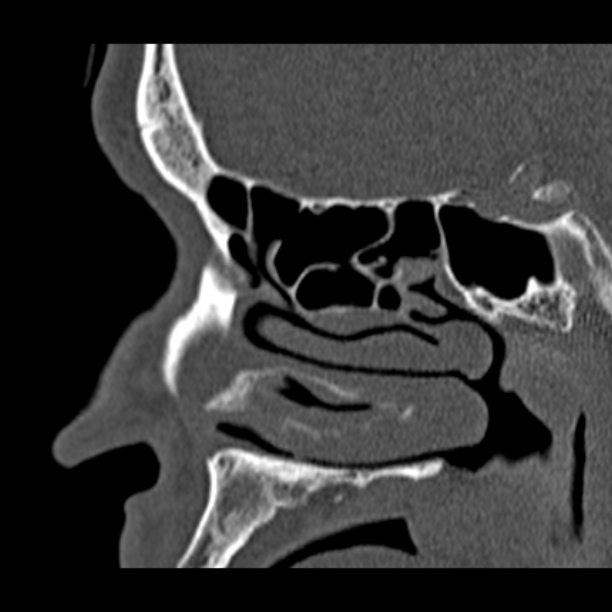 Chronic maxillary sinusitis (Radiopaedia 27879-28116 Sagittal bone window 34).jpg