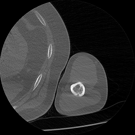Chronic osteomyelitis (Radiopaedia 67597-76998 Axial bone window 39).jpg