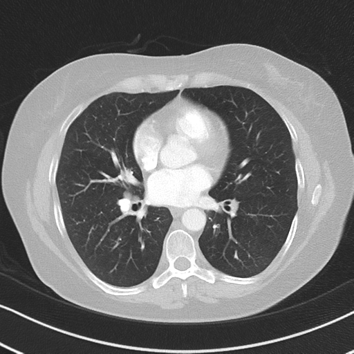File:Chronic pulmonary embolus (Radiopaedia 39129-41341 Axial lung window 36).png