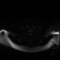 Chronic submandibular sialadenitis (Radiopaedia 61852-69885 Axial DWI 24).jpg
