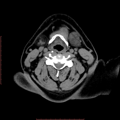 File:Chronic submandibular sialolithiasis (Radiopaedia 69817-79814 Axial non-contrast 144).jpg